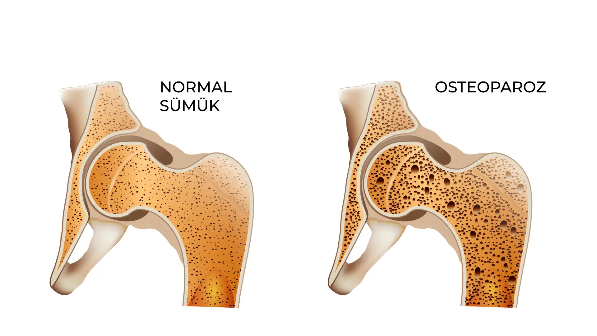 osteoparoz sümük erimesi