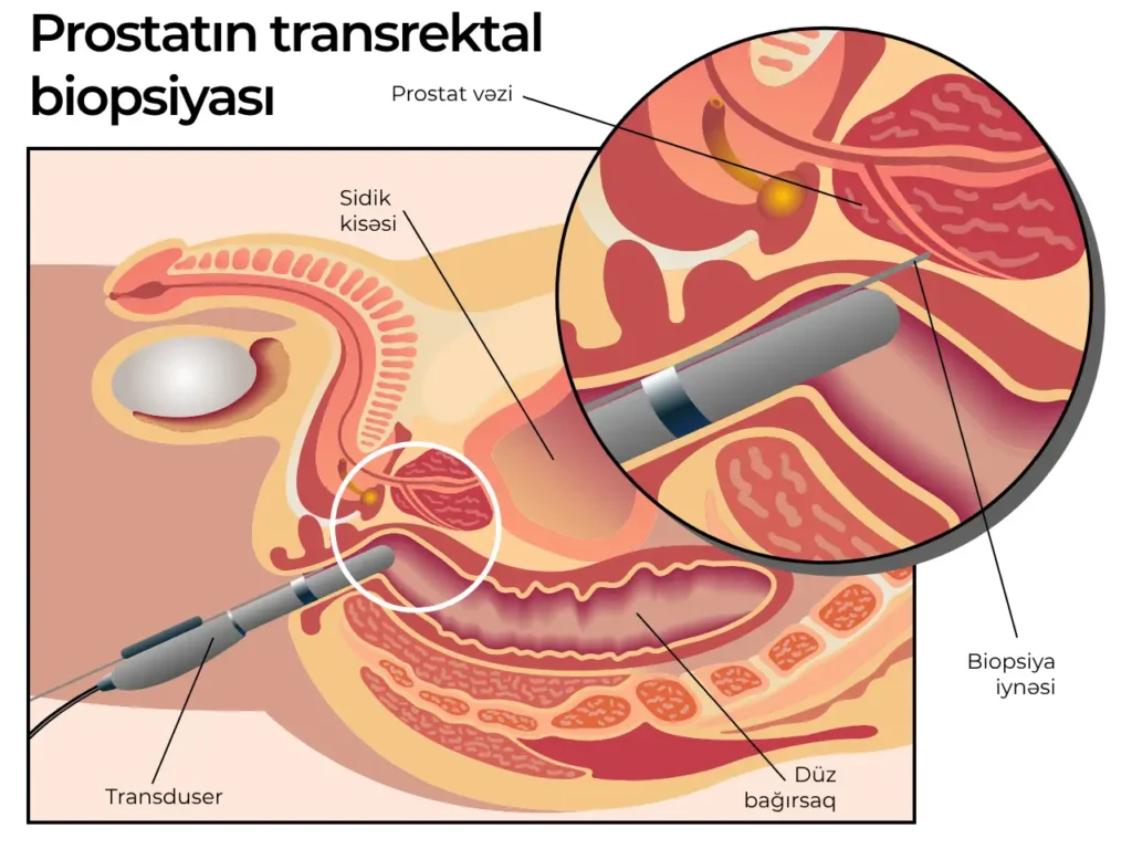 prostat vezin biopsiyasi