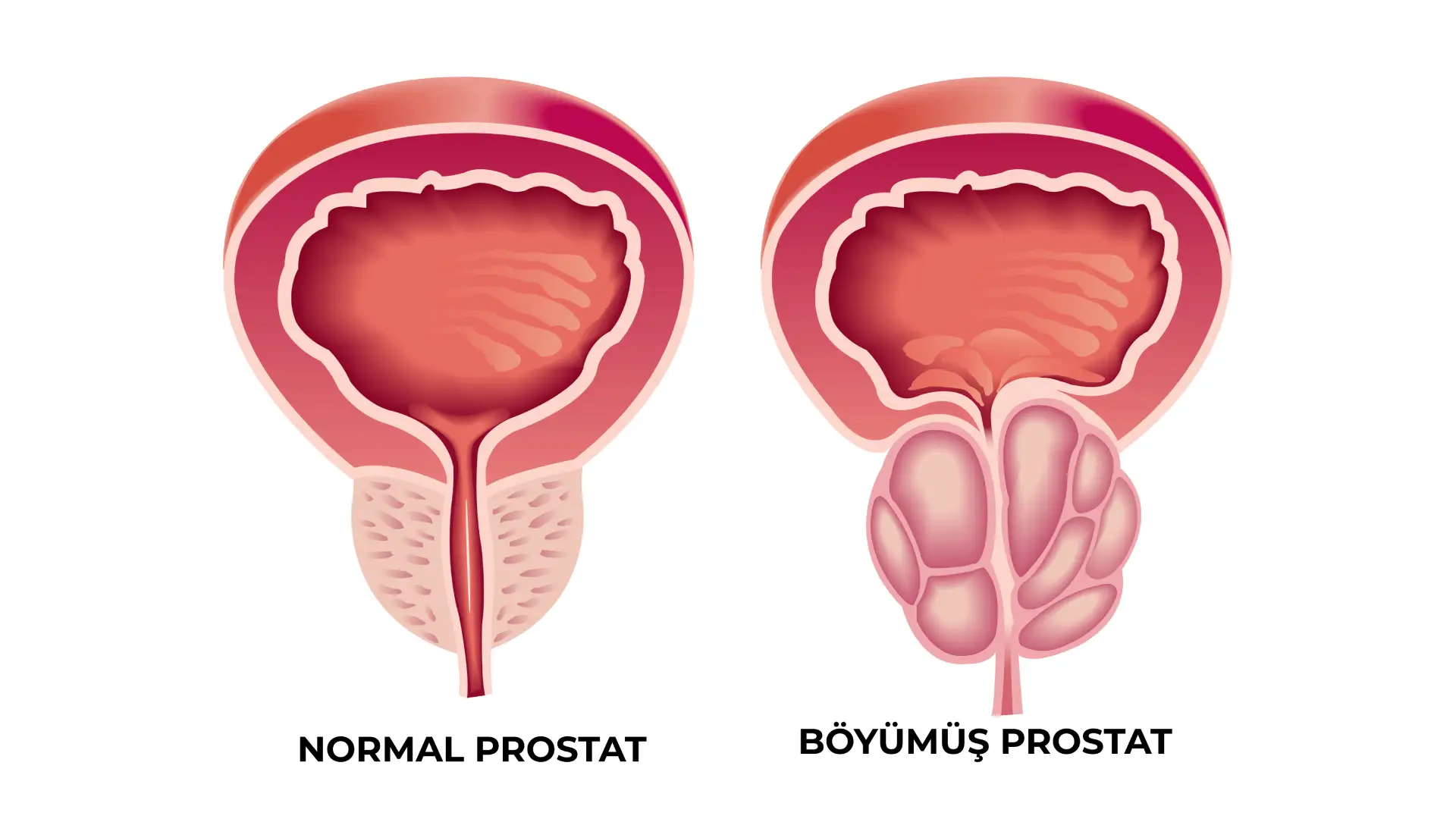 prostatin lazerle emeliyyati holep